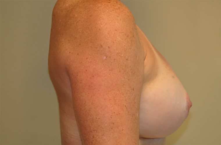 Breast revision patient photo, side profile view of the breasts — Dr. Rudderman, Atlanta.