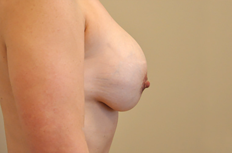 Breast revision patient photo, side profile view of the breasts — Dr. Rudderman, Atlanta.