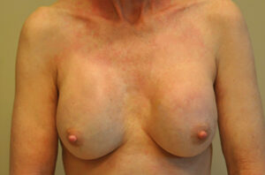 Breast revision patient photo, front view of the breasts — Dr. Rudderman, Atlanta.