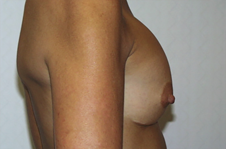 Breast revision patient photo, side profile view of the breasts — Dr. Rudderman, Atlanta.