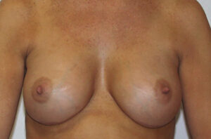 Breast revision patient photo, front view of the breasts — Dr. Rudderman, Atlanta.