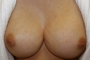 Breast revision patient photo, front view of the breasts — Dr. Rudderman, Atlanta.