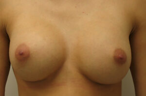 Breast revision patient photo, front view of the breasts — Dr. Rudderman, Atlanta.
