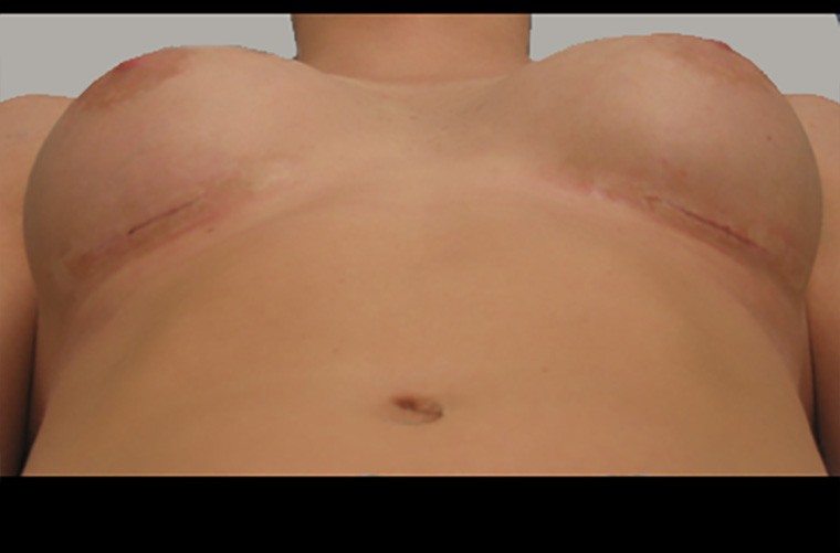 Breast revision patient photo, front view of the breasts — Dr. Rudderman, Atlanta.