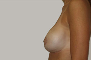Breast revision patient photo, side profile view of the breasts — Dr. Rudderman, Atlanta.