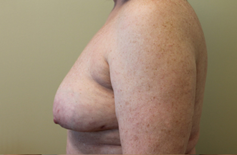 Capsular contracture treatment patient photo, side profile view of the breasts — Dr. Rudderman, Atlanta.