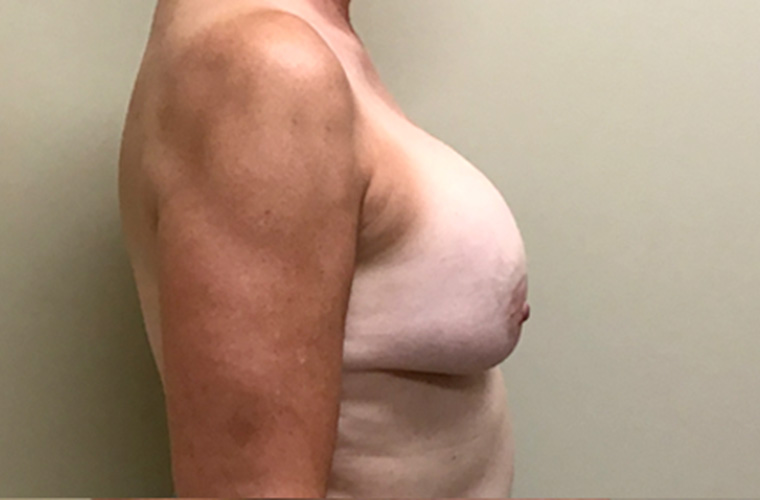 Capsular contracture treatment patient photo, side profile view of the breasts — Dr. Rudderman, Atlanta.