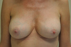 Capsular contracture treatment patient photo, front view of the breasts — Dr. Rudderman, Atlanta.