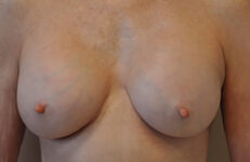Capsular contracture treatment patient photo, front view of the breasts — Dr. Rudderman, Atlanta.