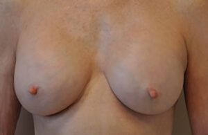 Capsular contracture treatment patient photo, front view of the breasts — Dr. Rudderman, Atlanta.