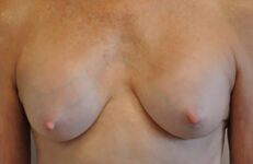 Capsular contracture treatment patient photo, front view of the breasts — Dr. Rudderman, Atlanta.