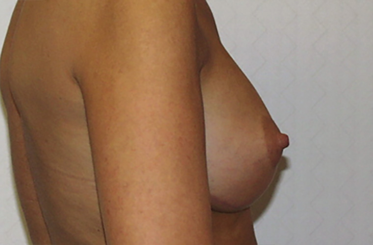 Capsular contracture treatment patient photo, side profile view of the breasts — Dr. Rudderman, Atlanta.