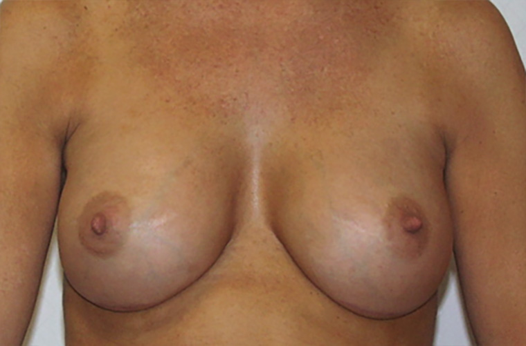 Capsular contracture treatment patient photo, front view of the breasts — Dr. Rudderman, Atlanta.