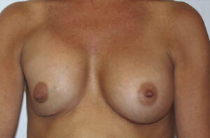 Capsular contracture treatment patient photo, front view of the breasts — Dr. Rudderman, Atlanta.
