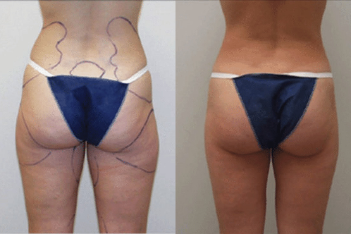 Before and after liposuction, back view of the buttocks and thighs — Dr. Rudderman, Atlanta.
