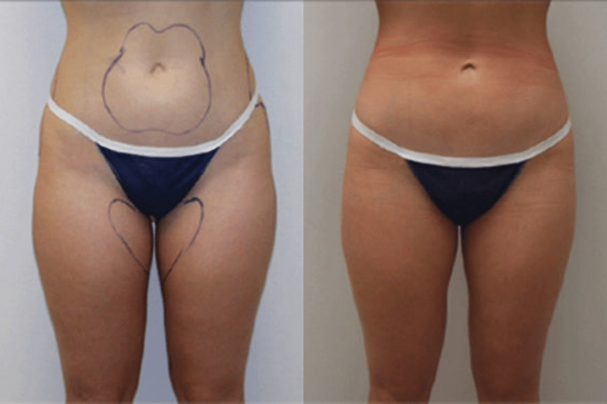 Before and after liposuction, front view of the abdomen and thighs — Dr. Rudderman, Atlanta.