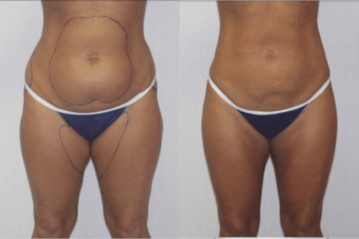 Before and after liposuction, front view of the abdomen and thighs — Dr. Rudderman, Atlanta.