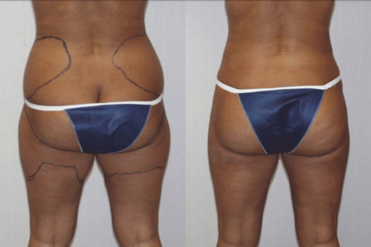 Before and after liposuction, back view of the buttocks and thighs — Dr. Rudderman, Atlanta.