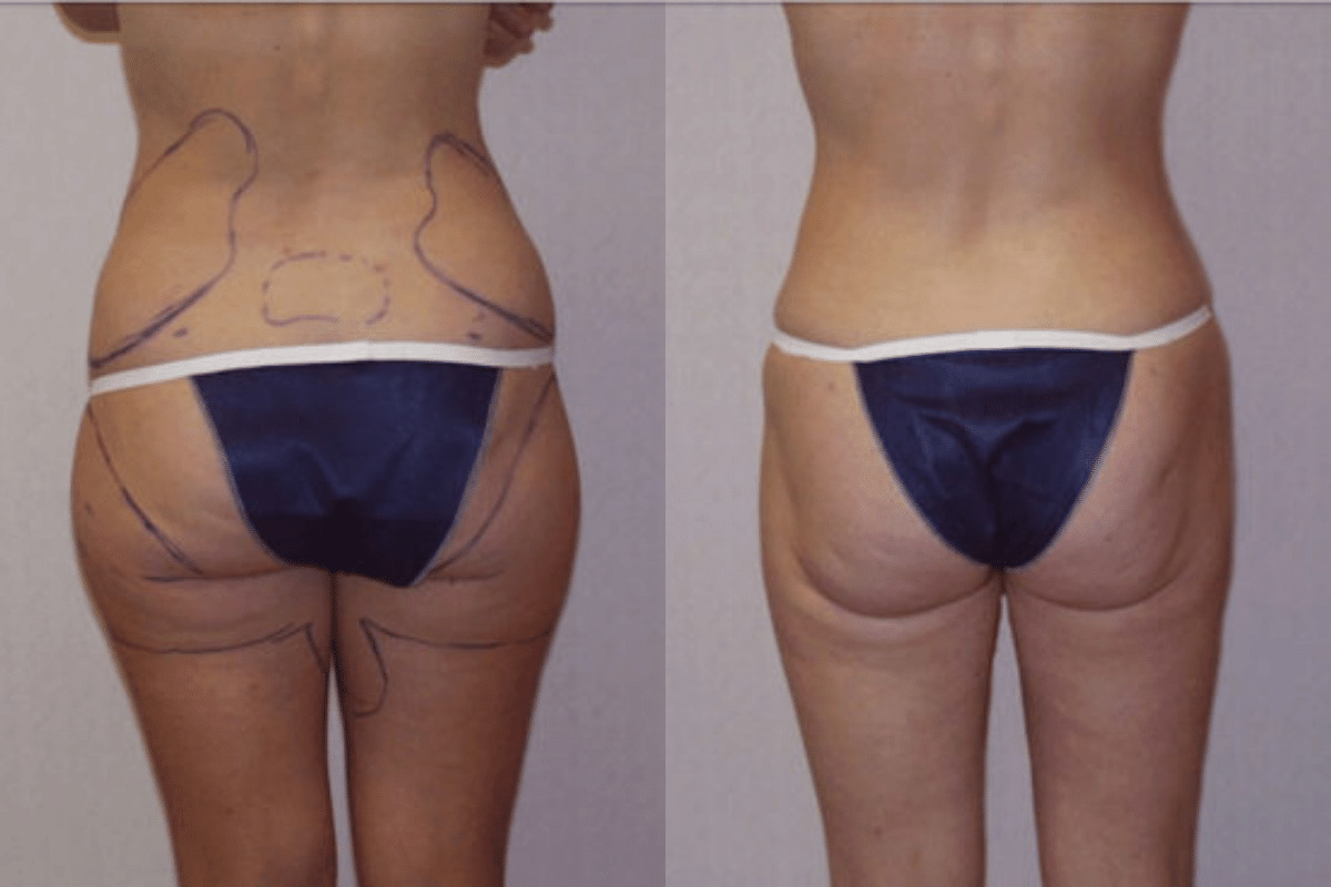 Before and after liposuction, back view of the buttocks and thighs — Dr. Rudderman, Atlanta.