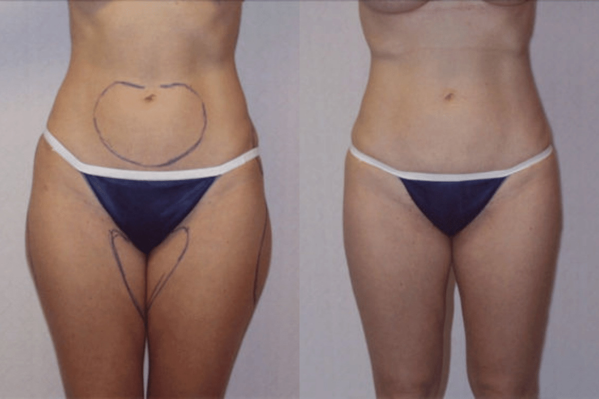 Before and after liposuction, front view of the abdomen and thighs — Dr. Rudderman, Atlanta.