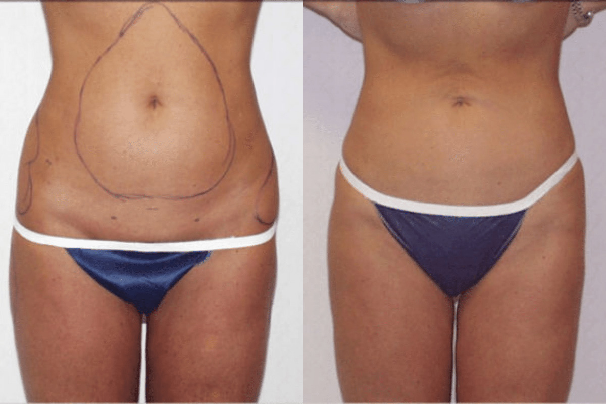 Before and after liposuction, front view of the abdomen — Dr. Rudderman, Atlanta.