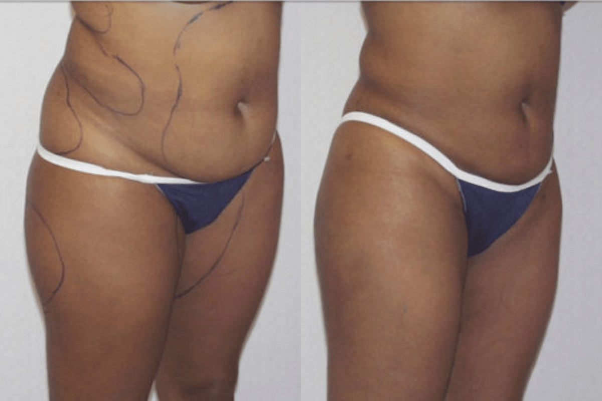 Before and after liposuction, three-quarter view of the abdomen and flanks — Dr. Rudderman, Atlanta.