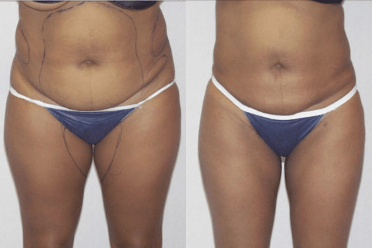 Before and after liposuction, front view of the abdomen — Dr. Rudderman, Atlanta.