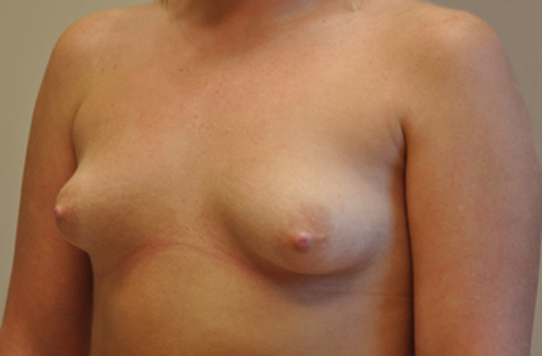 Breasts before tuberous breast correction, three-quarter view — Dr. Rudderman, Atlanta.