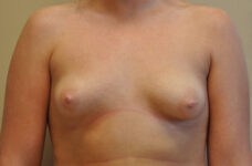 Breasts before tuberous breast correction, front view — Dr. Rudderman, Atlanta.