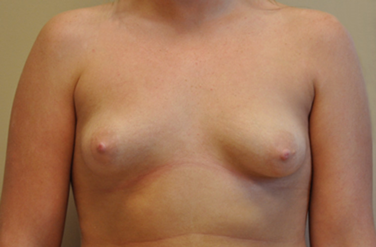 Breasts before tuberous breast correction, front view — Dr. Rudderman, Atlanta.