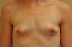 Breasts before tuberous breast correction, front view — Dr. Rudderman, Atlanta.