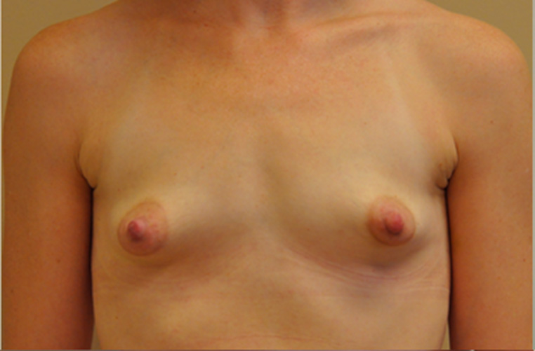 Breasts before tuberous breast correction, front view — Dr. Rudderman, Atlanta.