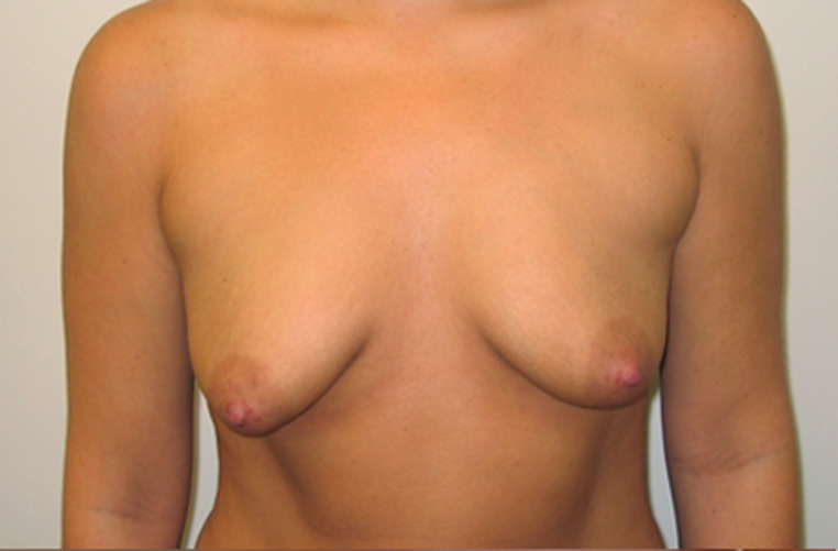 Breasts before tuberous breast correction, front view — Dr. Rudderman, Atlanta.