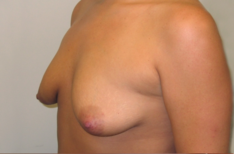 Breasts before tuberous breast correction, side profile view — Dr. Rudderman, Atlanta.