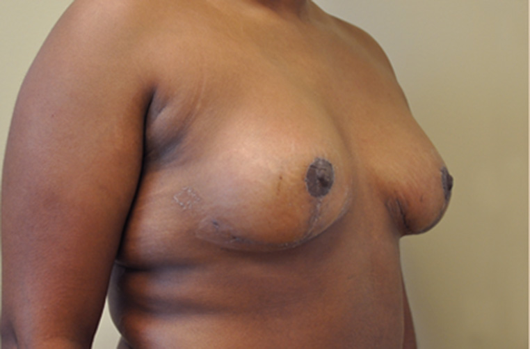 Breasts before tuberous breast correction, side profile view — Dr. Rudderman, Atlanta.