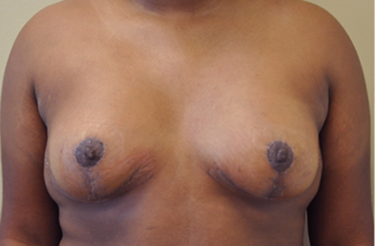 Breasts after tuberous breast correction, front view — Dr. Rudderman, Atlanta.
