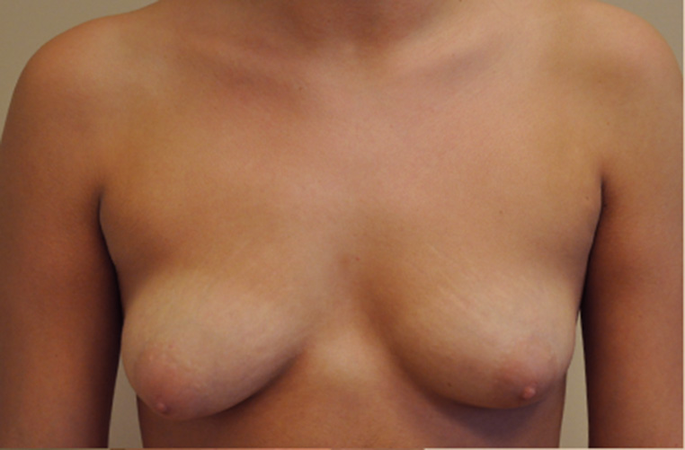 Breasts before tuberous breast correction, front view — Dr. Rudderman, Atlanta.