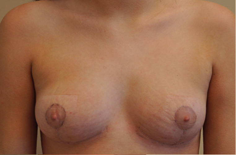Breasts after tuberous breast correction, front view — Dr. Rudderman, Atlanta.