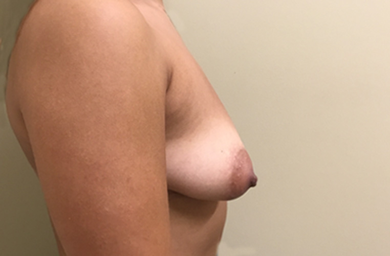 Breasts before tuberous breast correction, side profile view — Dr. Rudderman, Atlanta.