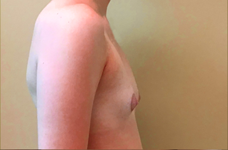 Breasts before tuberous breast correction, side profile view — Dr. Rudderman, Atlanta.
