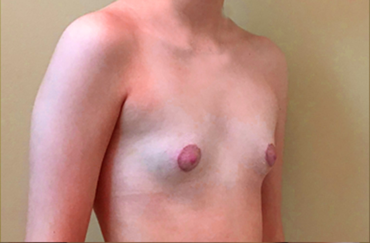 Breasts before tuberous breast correction, three-quarter view — Dr. Rudderman, Atlanta.