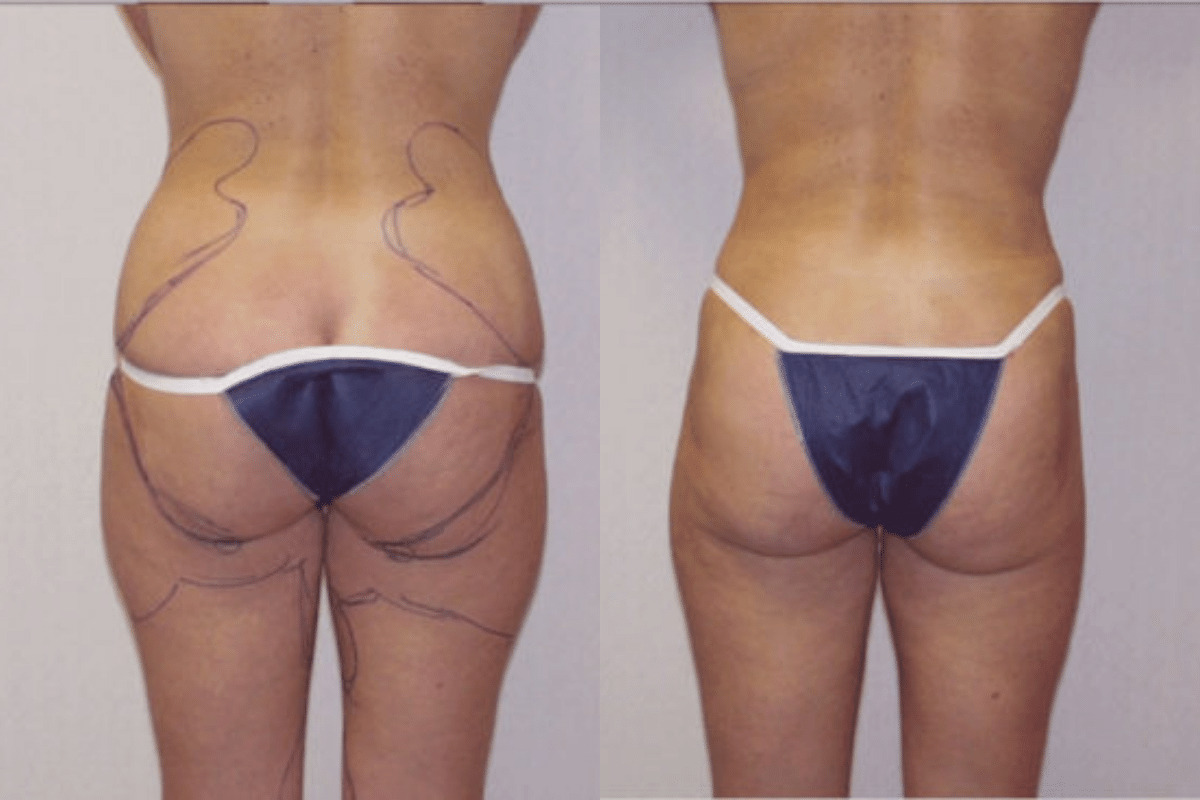Before and after liposuction, back view of the buttocks and thighs — Dr. Rudderman, Atlanta.