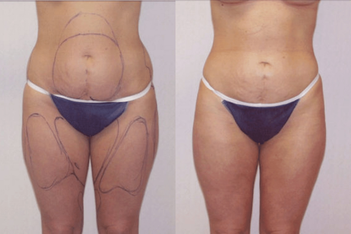 Before and after liposuction, front view of the abdomen and thighs — Dr. Rudderman, Atlanta.