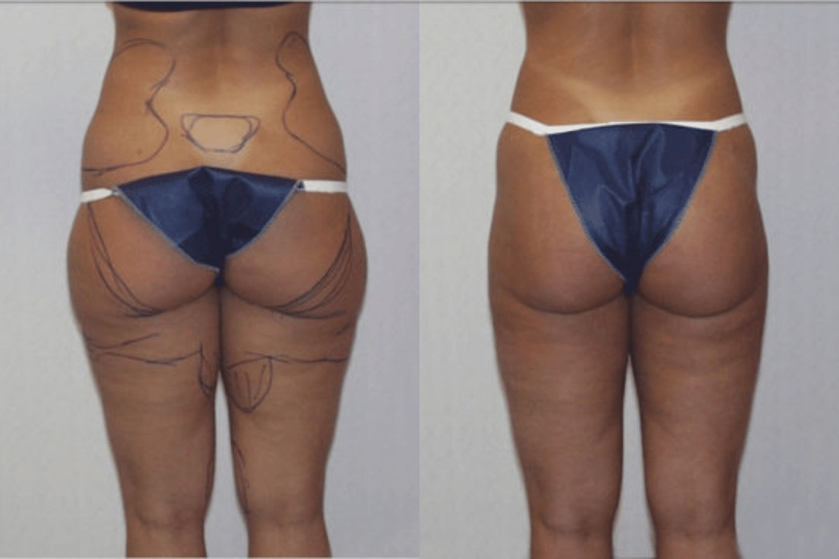 Before and after liposuction, back view of the buttocks and thighs — Dr. Rudderman, Atlanta.