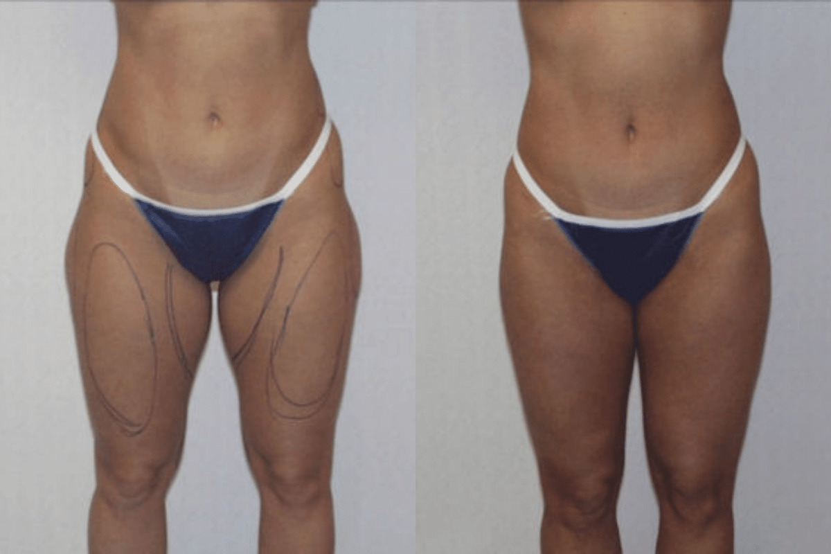 Before and after liposuction, front view of the abdomen and thighs — Dr. Rudderman, Atlanta.