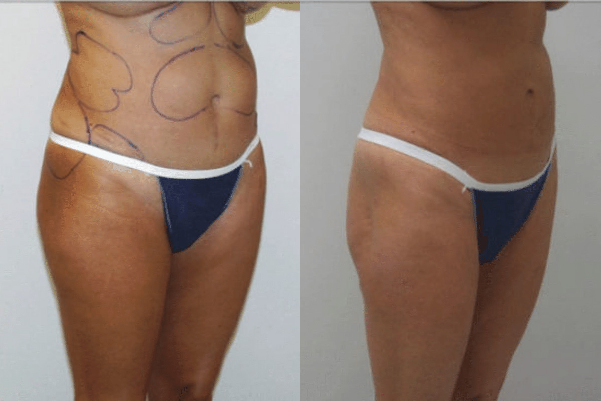 Before and after liposuction, three-quarter view of the abdomen and flanks — Dr. Rudderman, Atlanta.