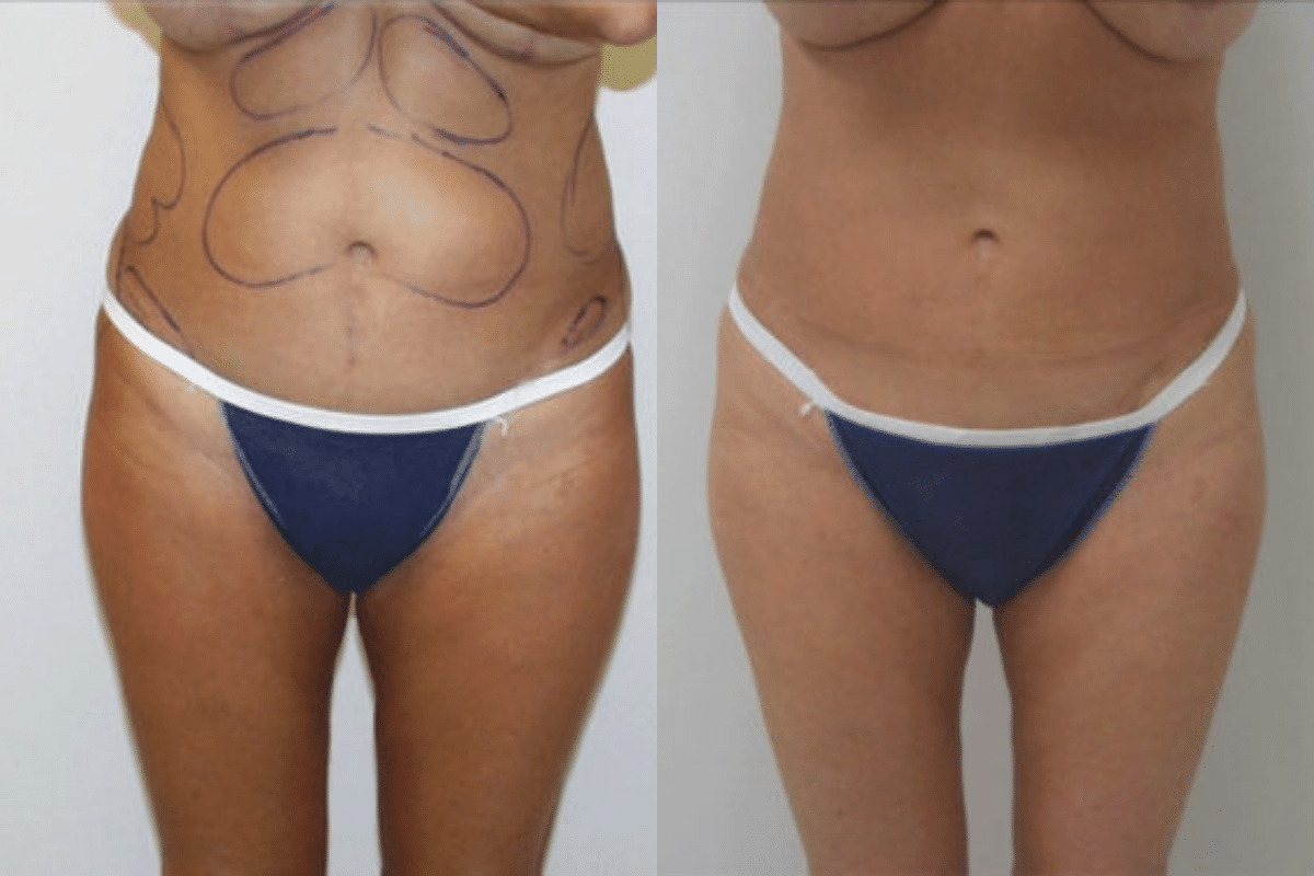 Before and after liposuction, front view of the abdomen — Dr. Rudderman, Atlanta.