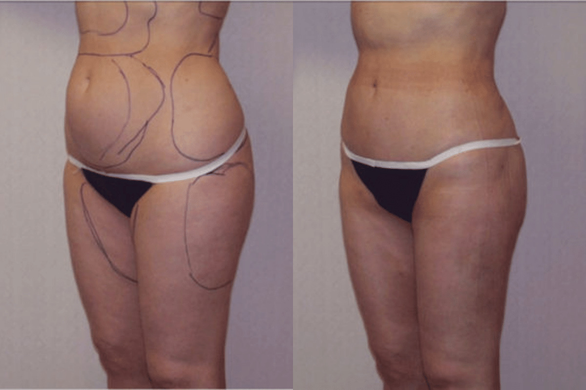 Before and after liposuction, three-quarter view of the abdomen and flanks — Dr. Rudderman, Atlanta.