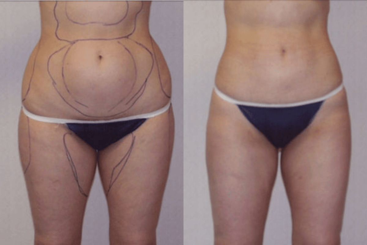Before and after liposuction, front view of the abdomen and thighs — Dr. Rudderman, Atlanta.