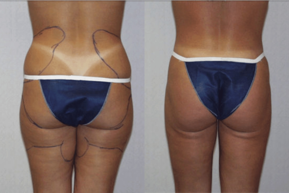 Before and after liposuction, back view of the buttocks and thighs — Dr. Rudderman, Atlanta.